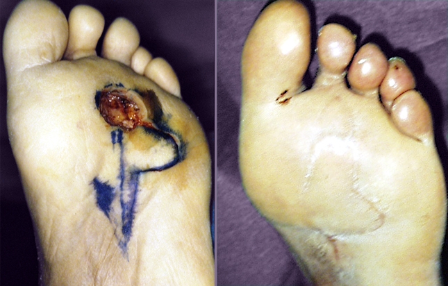 One year after the excision of ulcer soles